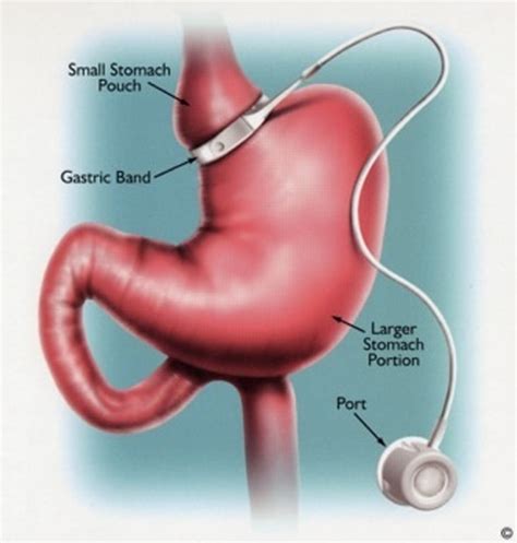 gastric bypass beverly hills|The Best Weight Loss Surgery, Lap Band (Band .